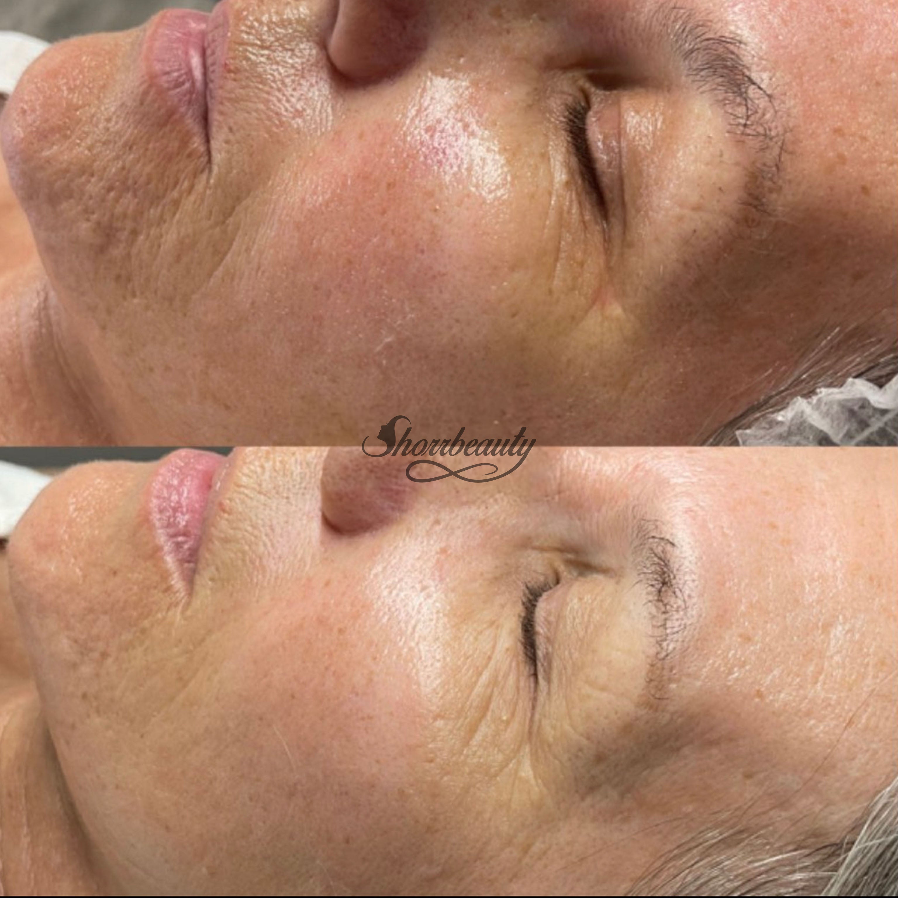 microchanelling before and after on face